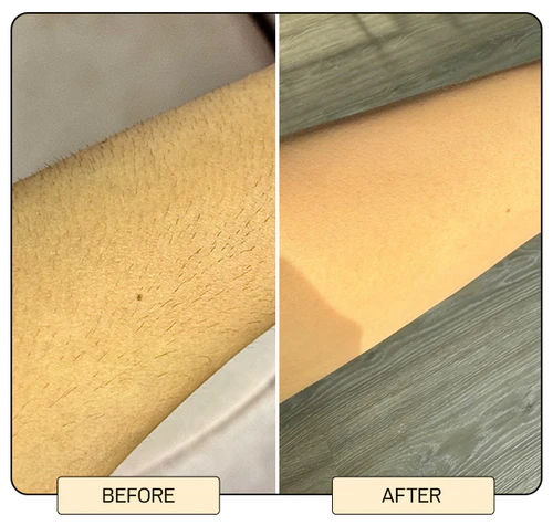 IPL Laser Hair Removal Device