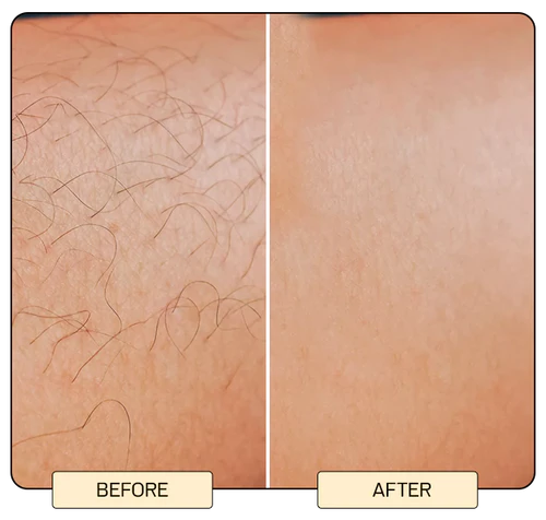 IPL Laser Hair Removal Device