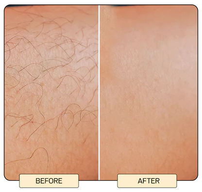 IPL Laser Hair Removal Device