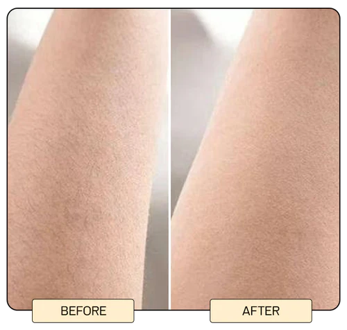 IPL Laser Hair Removal Device